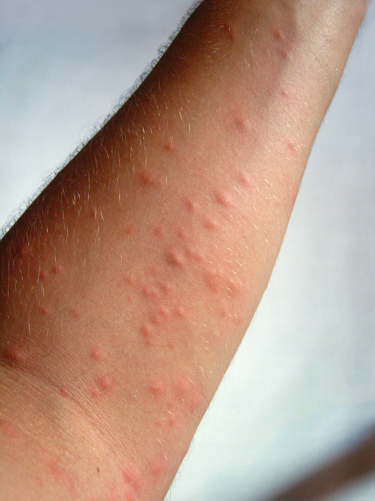Hautausschlag durch Brennhaare (Raupendermatitis)